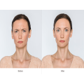 Komplexe Botox -Injektionen Gesichtsgewichtsverlust